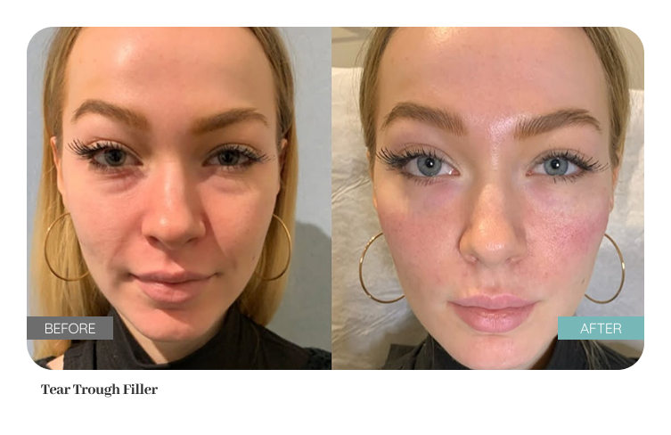 Before and after result